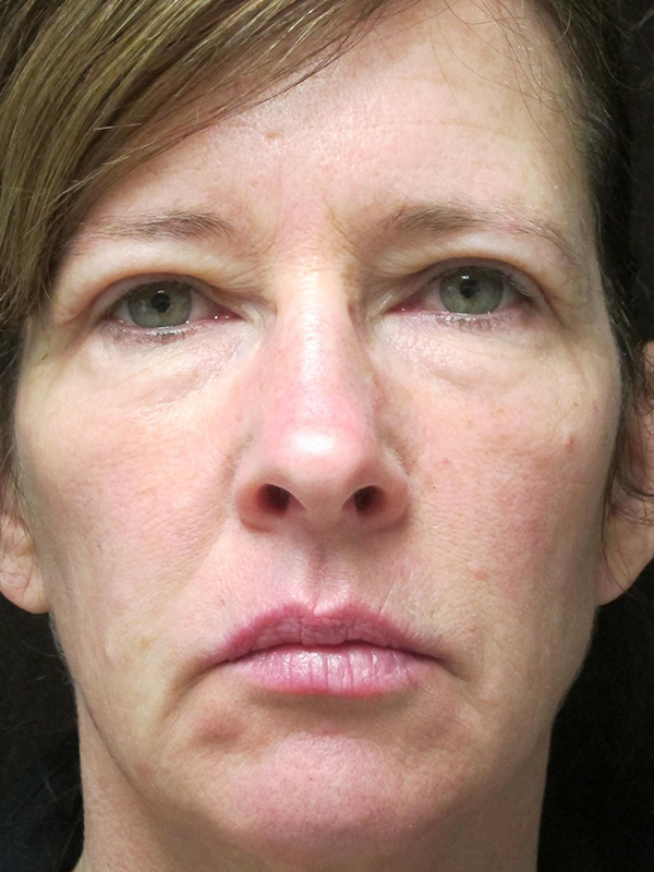 Brow Lift And Blepharoplasty Before and After | Montilla Plastic Surgery