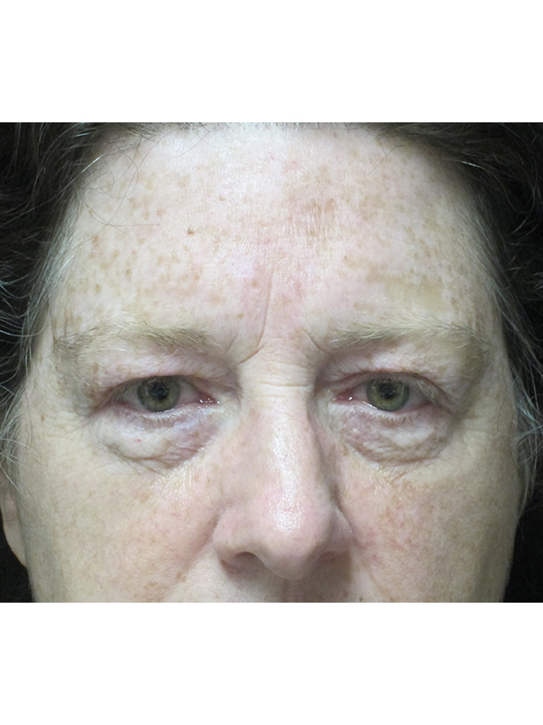 Brow Lift And Blepharoplasty Before and After | Montilla Plastic Surgery