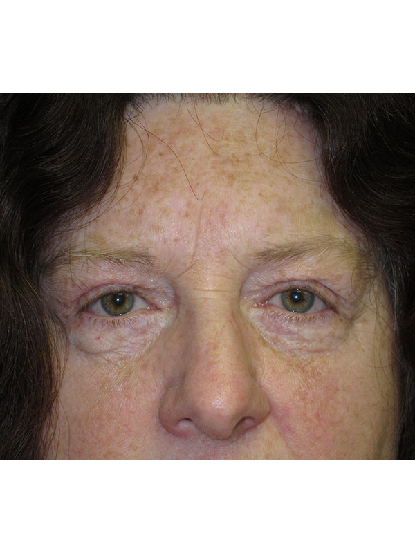 Brow Lift And Blepharoplasty Before and After | Montilla Plastic Surgery