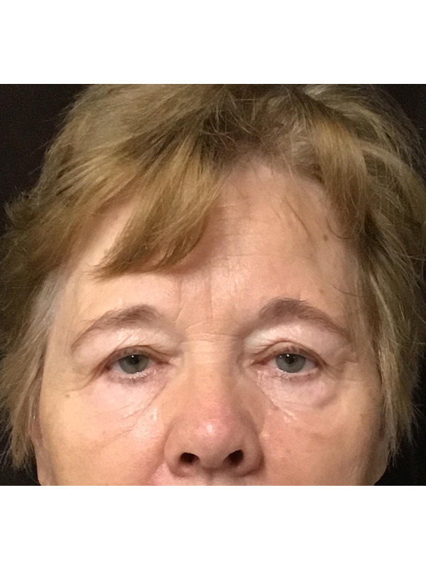 Brow Lift And Blepharoplasty Before and After | Montilla Plastic Surgery
