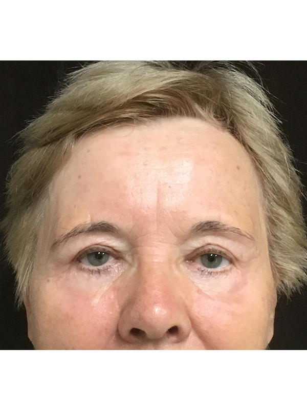 Brow Lift And Blepharoplasty Before and After | Montilla Plastic Surgery