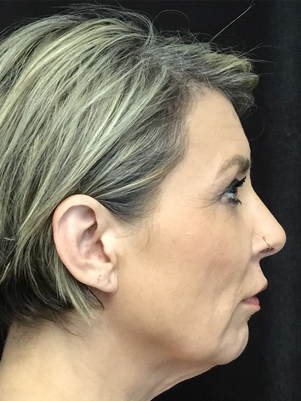 Chin Implant Before and After | Montilla Plastic Surgery