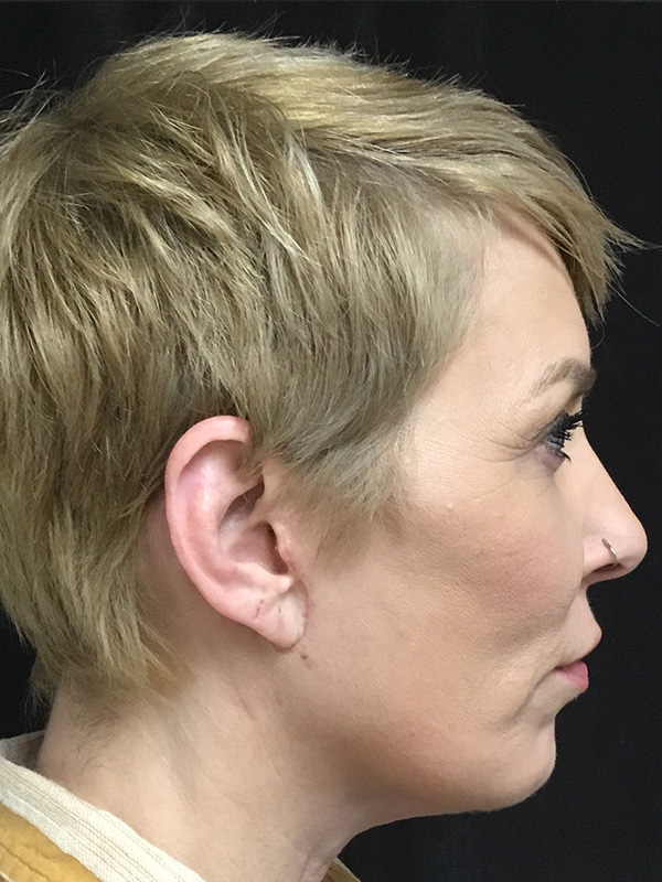 Chin Implant Before and After | Montilla Plastic Surgery