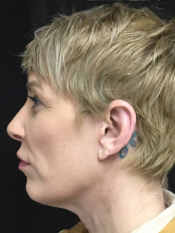 Chin Implant Before and After | Montilla Plastic Surgery