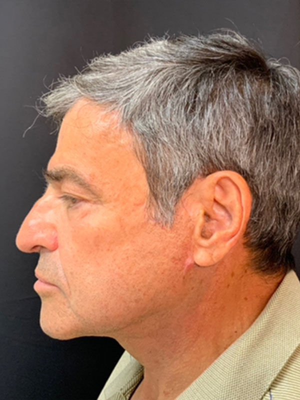 Facelift Before and After | Montilla Plastic Surgery 