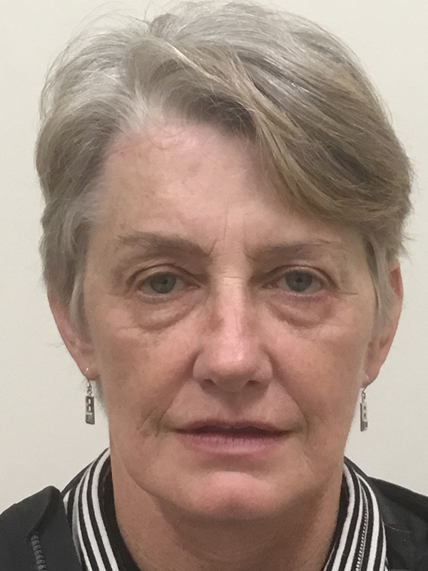 Facelift Before and After | Montilla Plastic Surgery 