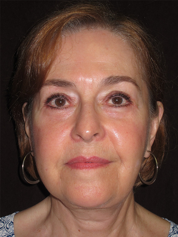 Facelift Before and After | Montilla Plastic Surgery 