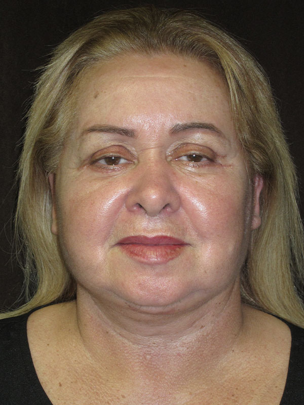 Facelift Before and After | Montilla Plastic Surgery 