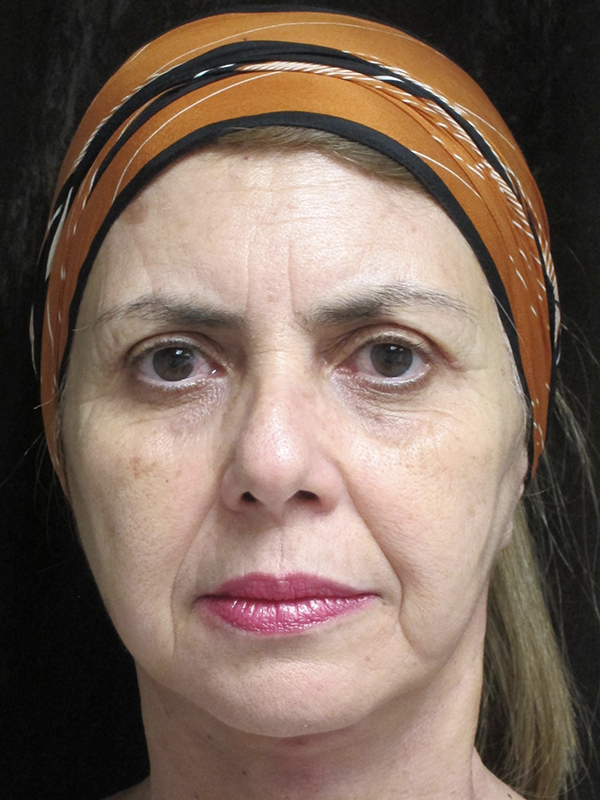 Facelift Before and After | Montilla Plastic Surgery 