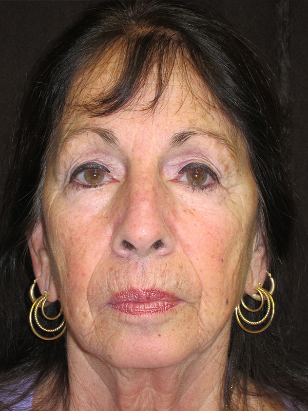Fat Grafting Before and After | Montilla Plastic Surgery 