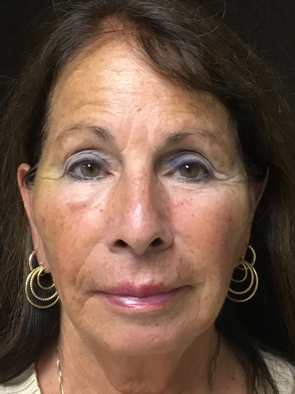 Fat Grafting Before and After | Montilla Plastic Surgery 