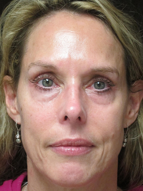 Fat Grafting Before and After | Montilla Plastic Surgery 