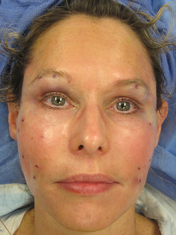 Fat Grafting Before and After | Montilla Plastic Surgery 