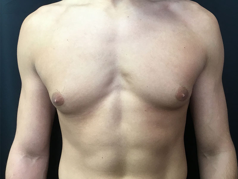 Gynecomastia Before and After | Montilla Plastic Surgery 