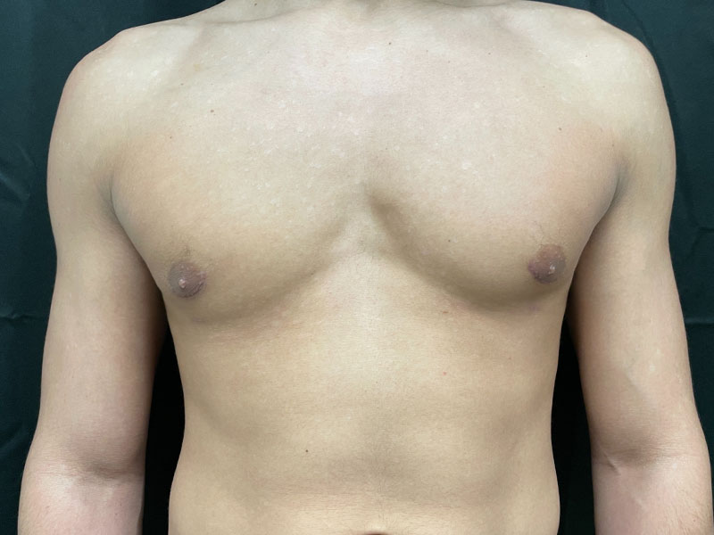 Gynecomastia Before and After | Montilla Plastic Surgery 