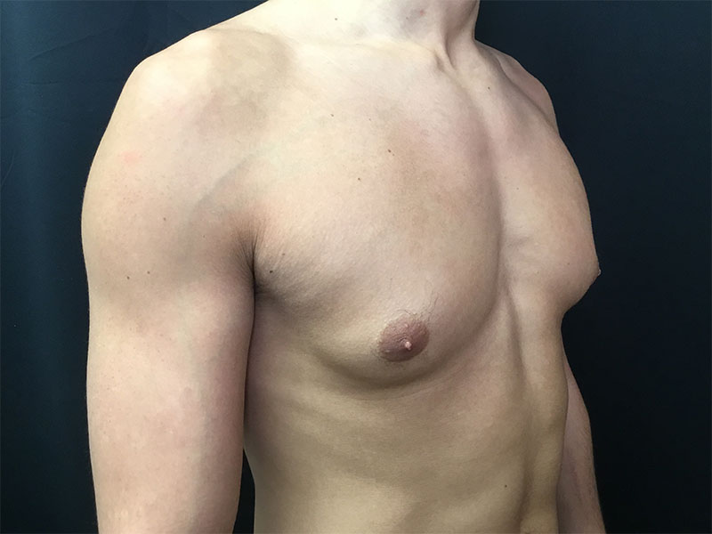 Gynecomastia Before and After | Montilla Plastic Surgery