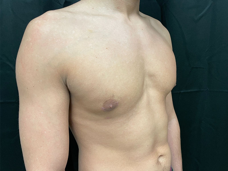 Gynecomastia Before and After | Montilla Plastic Surgery
