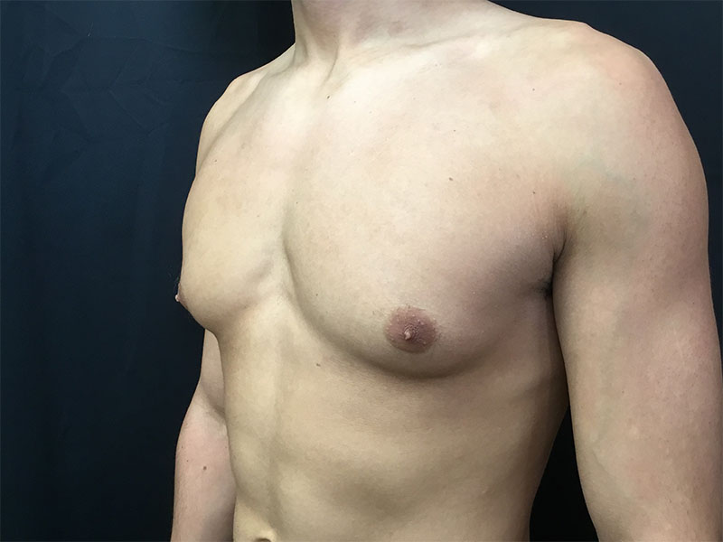 Gynecomastia Before and After | Montilla Plastic Surgery