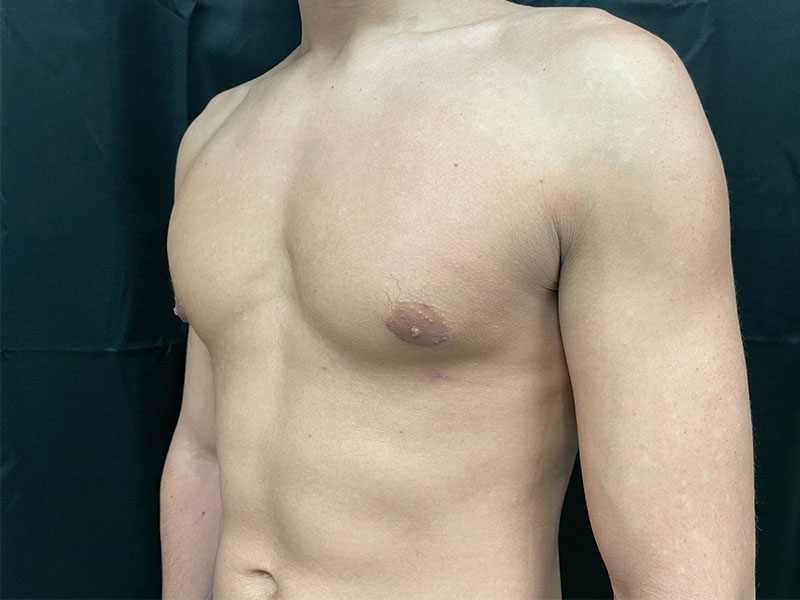 Gynecomastia Before and After | Montilla Plastic Surgery