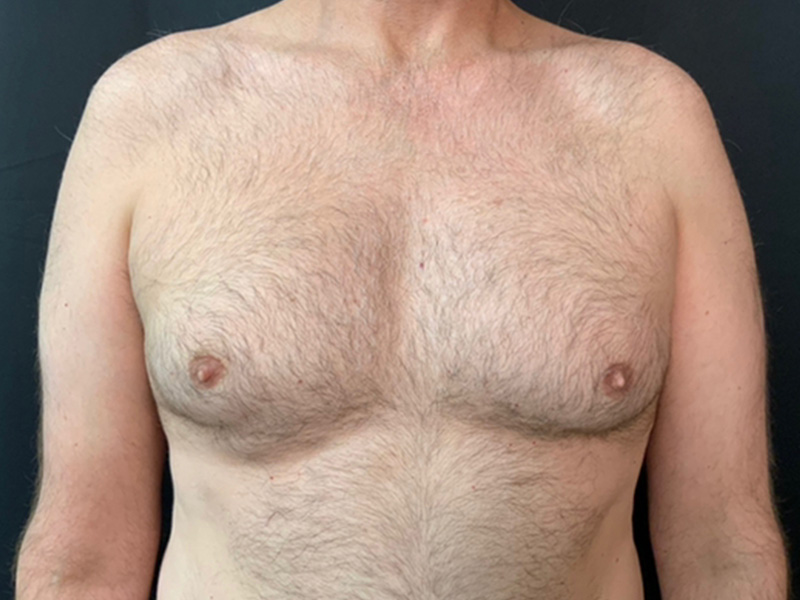 Gynecomastia Before and After | Montilla Plastic Surgery 