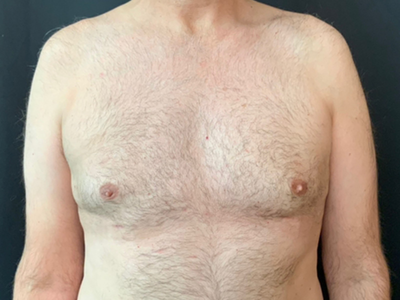 Gynecomastia Before and After | Montilla Plastic Surgery 