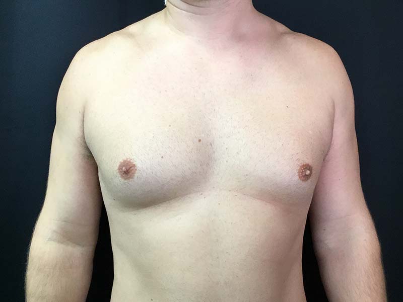 Gynecomastia Before and After | Montilla Plastic Surgery 