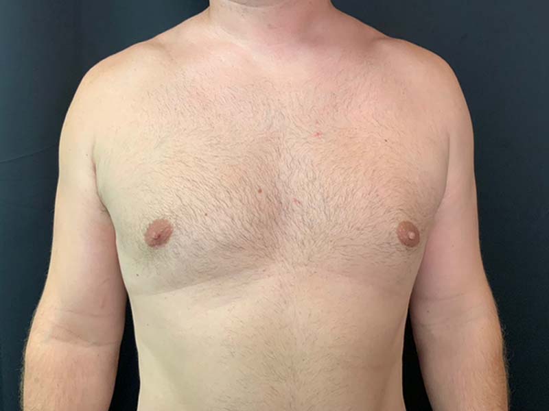 Gynecomastia Before and After | Montilla Plastic Surgery 