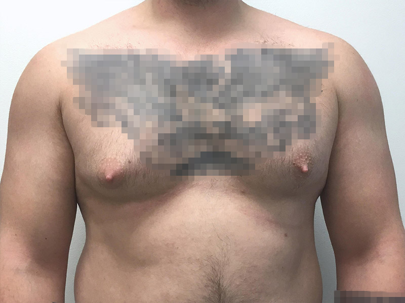 Gynecomastia Before and After | Montilla Plastic Surgery 