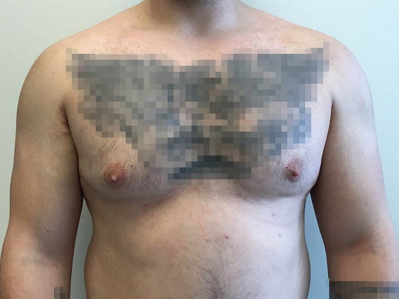 Gynecomastia Before and After | Montilla Plastic Surgery 