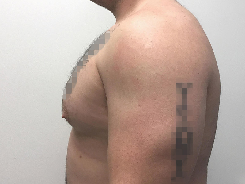 Gynecomastia Before and After | Montilla Plastic Surgery