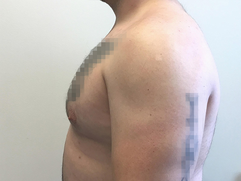 Gynecomastia Before and After | Montilla Plastic Surgery
