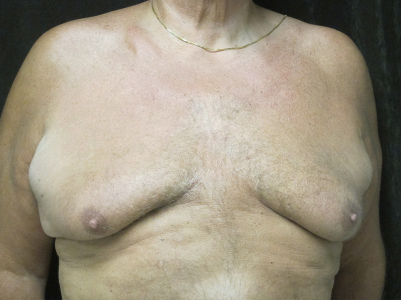 Gynecomastia Before and After | Montilla Plastic Surgery