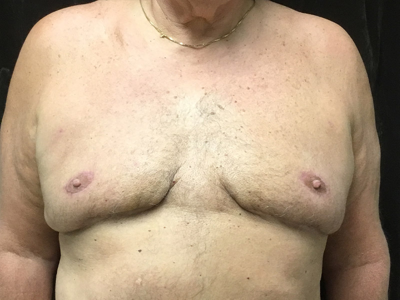 Gynecomastia Before and After | Montilla Plastic Surgery