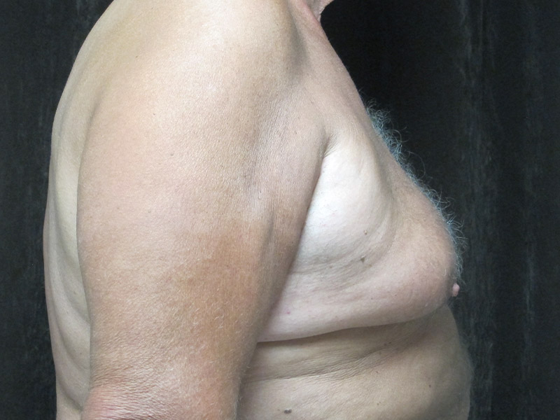 Gynecomastia Before and After | Montilla Plastic Surgery