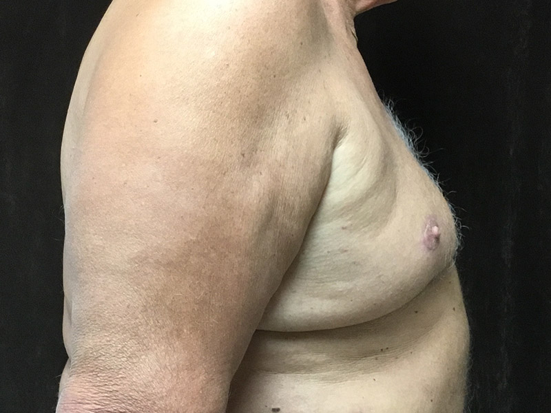 Gynecomastia Before and After | Montilla Plastic Surgery