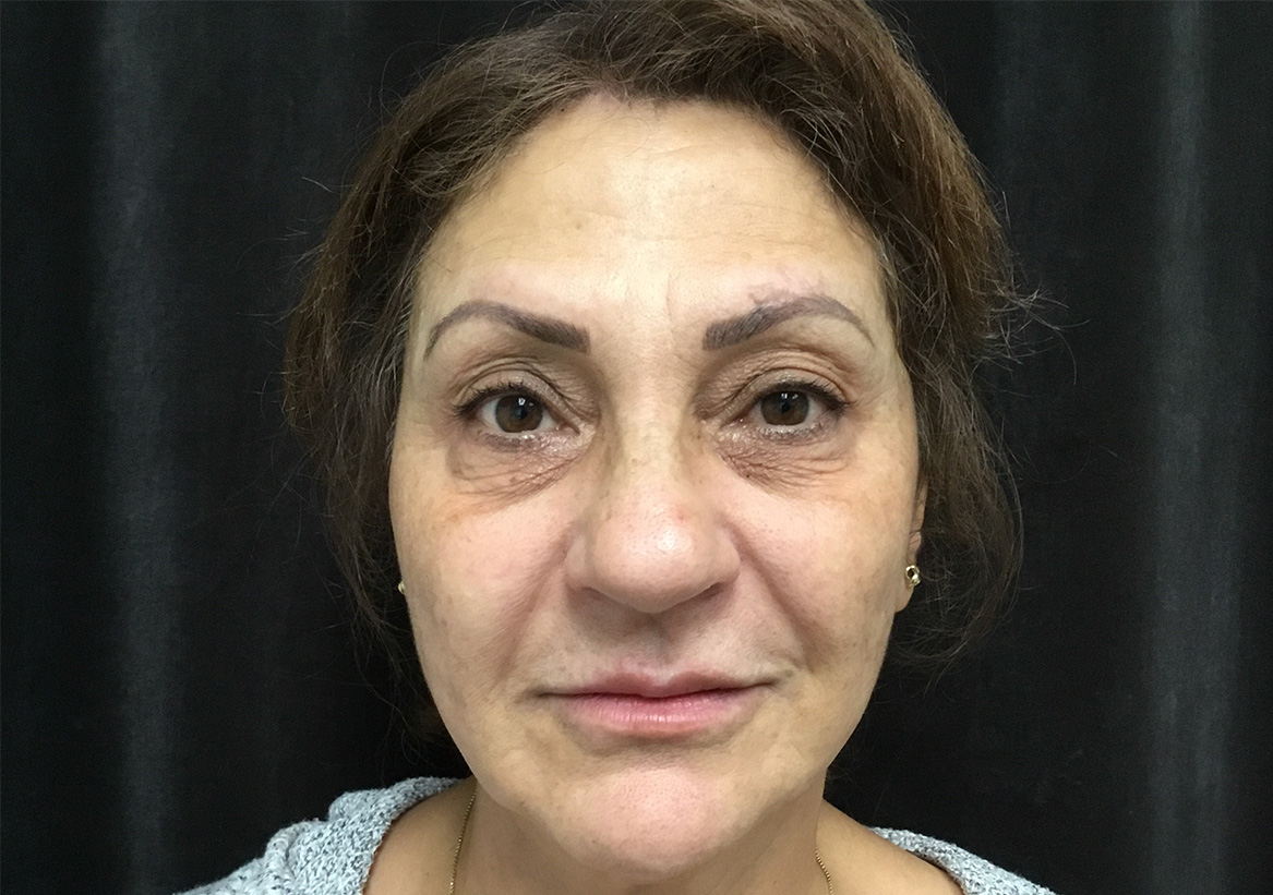 Hydrafacial Before and After | Montilla Plastic Surgery