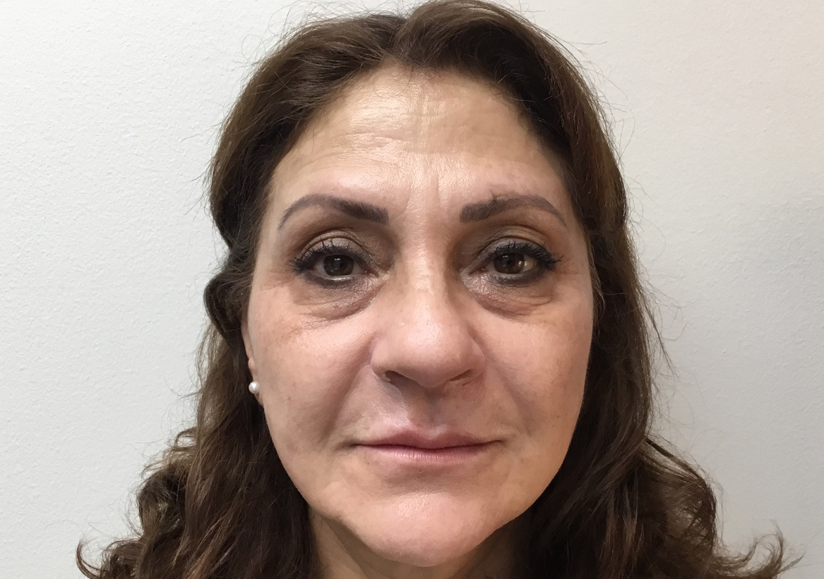 Hydrafacial Before and After | Montilla Plastic Surgery