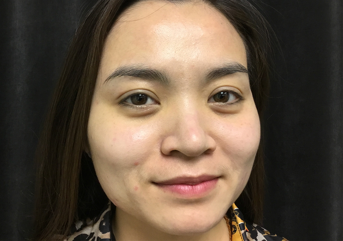 Hydrafacial Before and After | Montilla Plastic Surgery