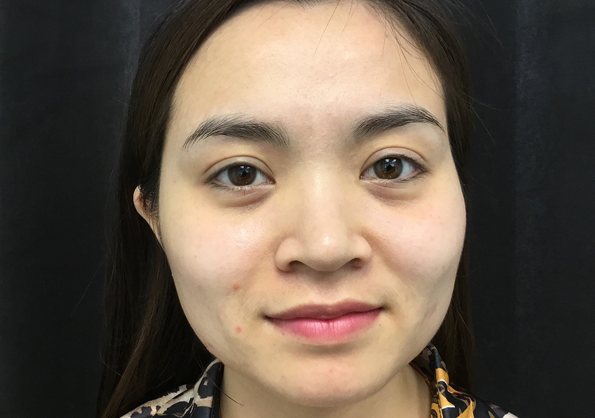 Hydrafacial Before and After | Montilla Plastic Surgery