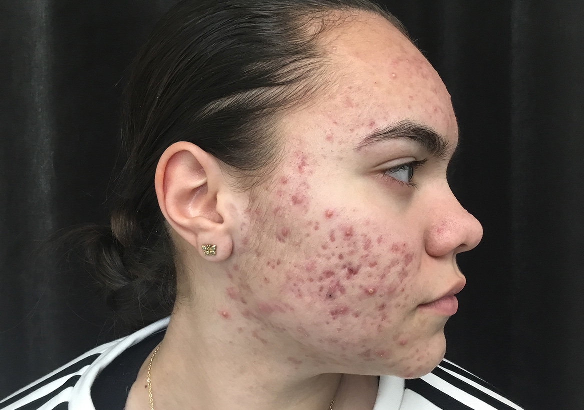 Hydrafacial Before and After | Montilla Plastic Surgery