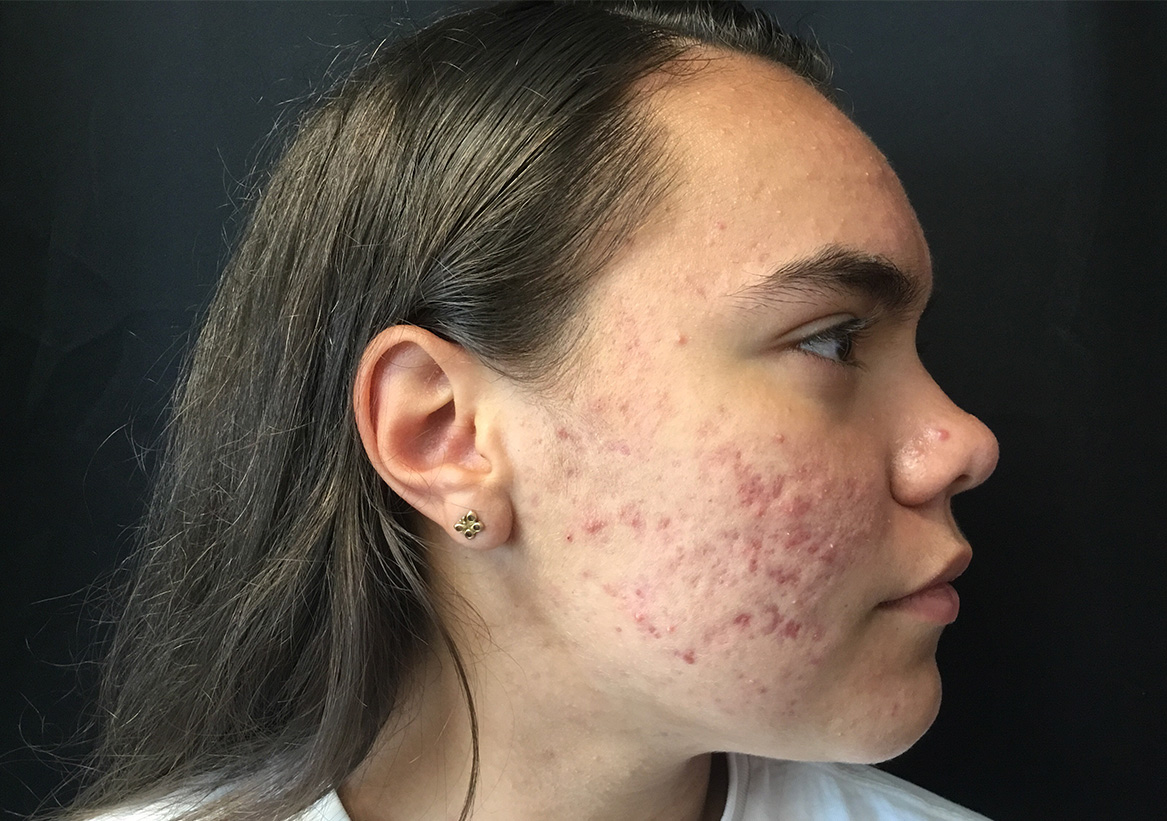 Hydrafacial Before and After | Montilla Plastic Surgery