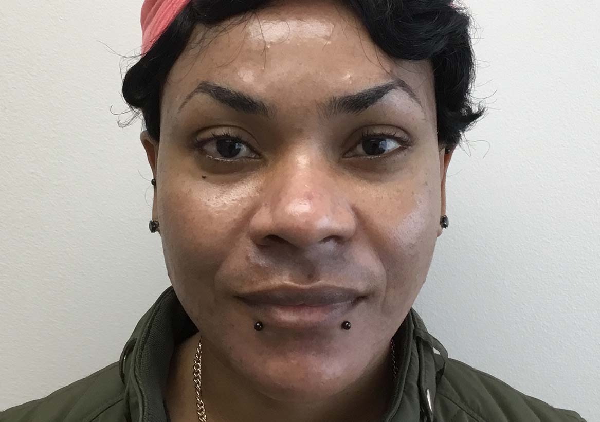 Hydrafacial Before and After | Montilla Plastic Surgery