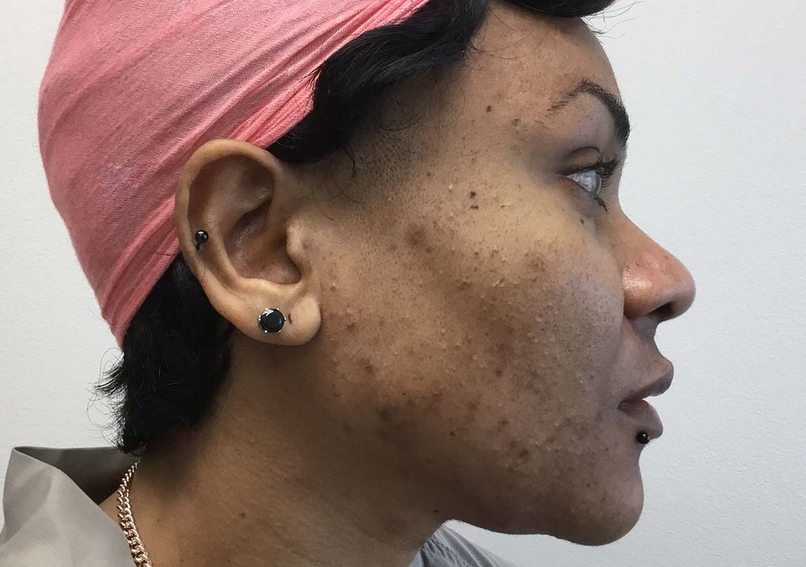 Hydrafacial Before and After | Montilla Plastic Surgery