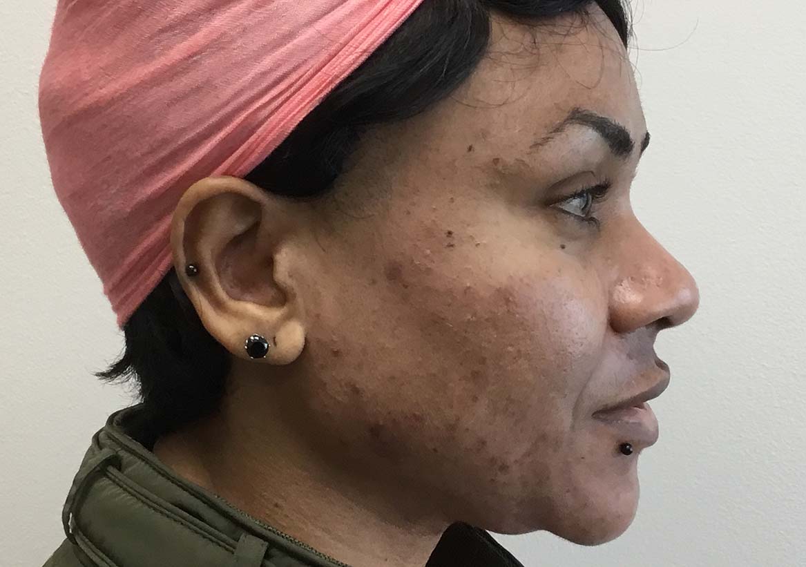 Hydrafacial Before and After | Montilla Plastic Surgery
