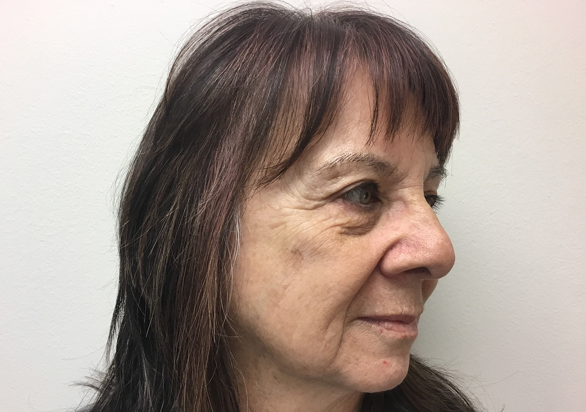 Hydrafacial Before and After | Montilla Plastic Surgery