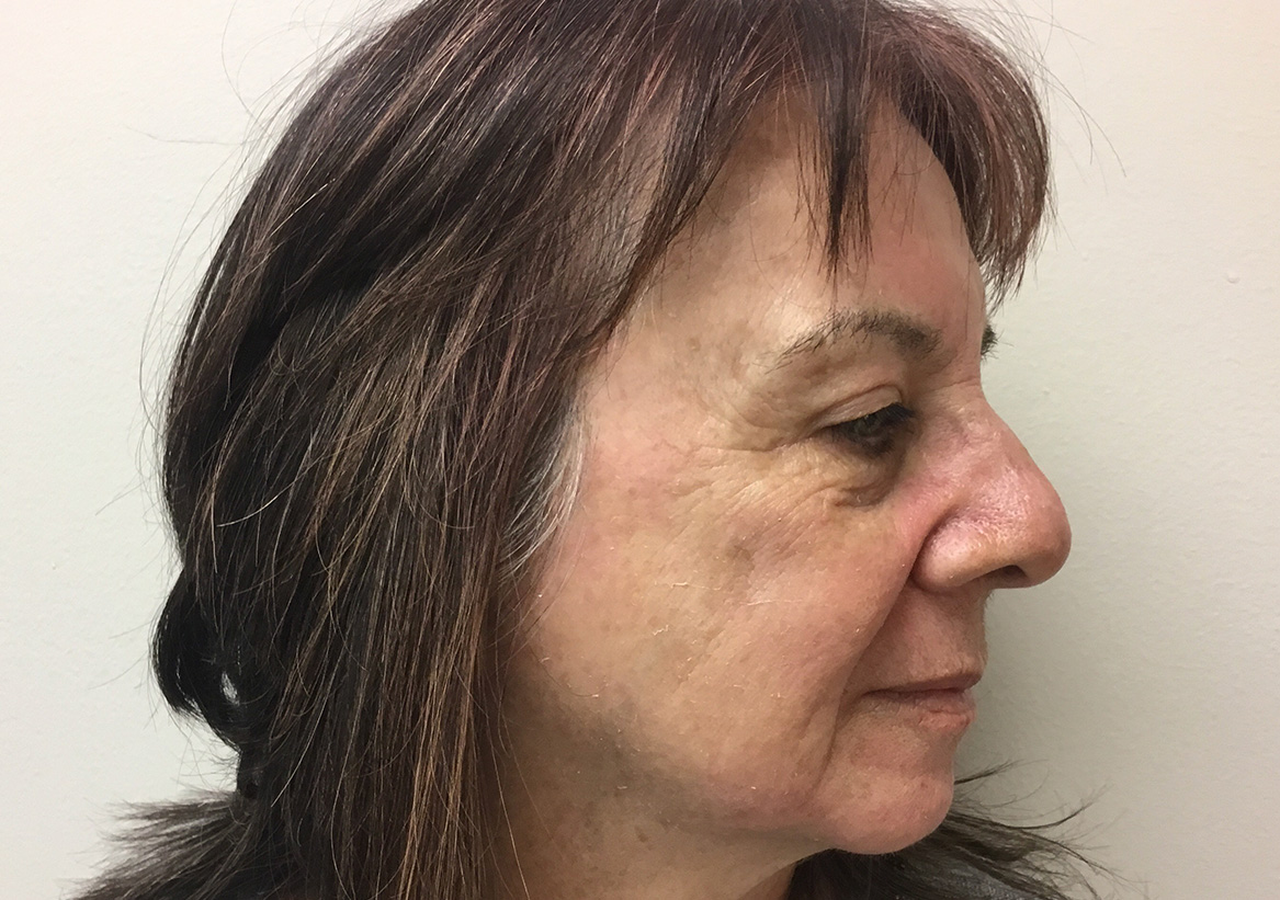 Hydrafacial Before and After | Montilla Plastic Surgery