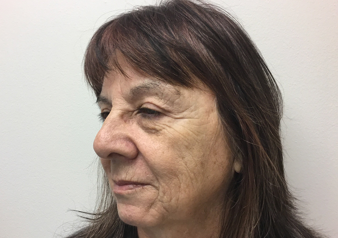 Hydrafacial Before and After | Montilla Plastic Surgery