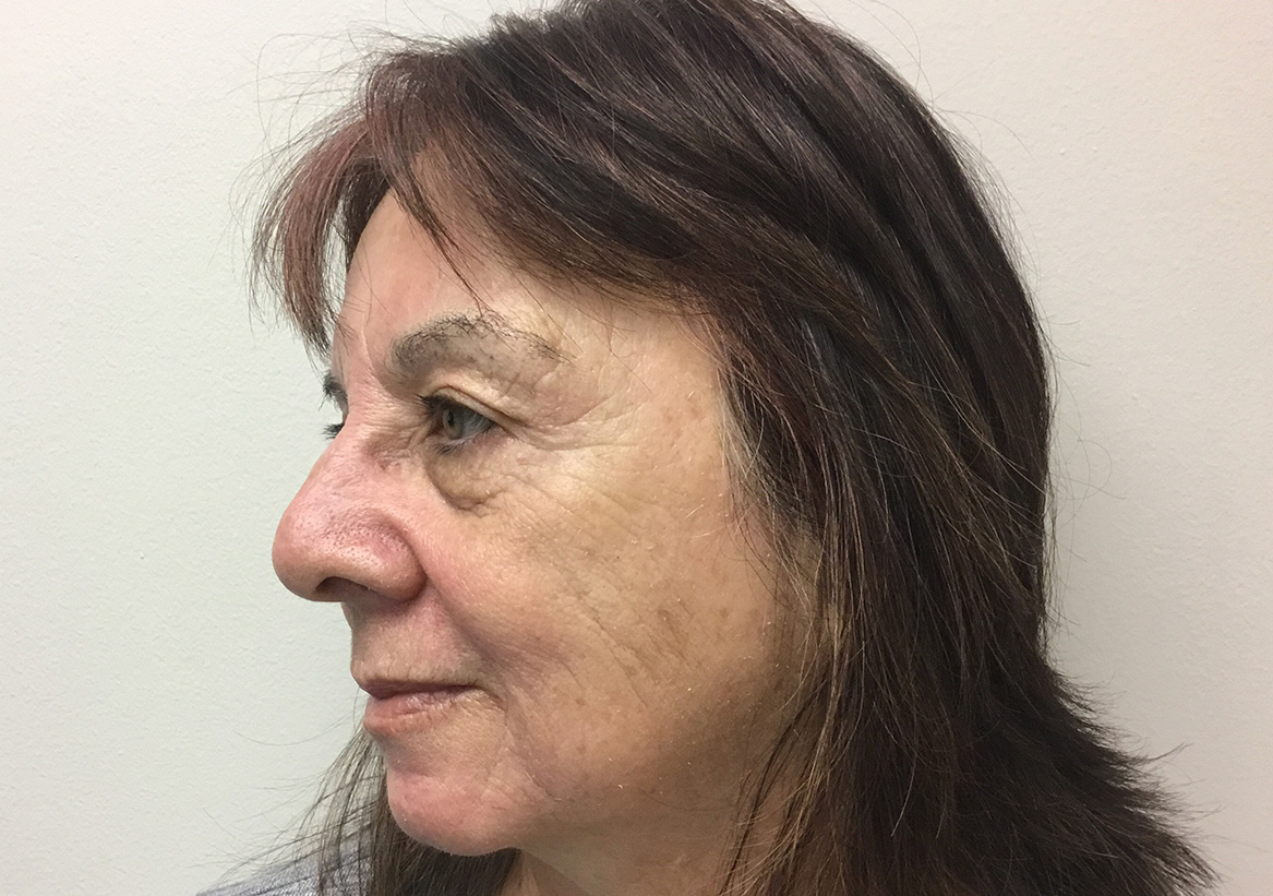 Hydrafacial Before and After | Montilla Plastic Surgery