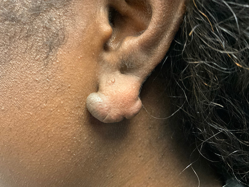 Keloid Removal Before and After | Montilla Plastic Surgery