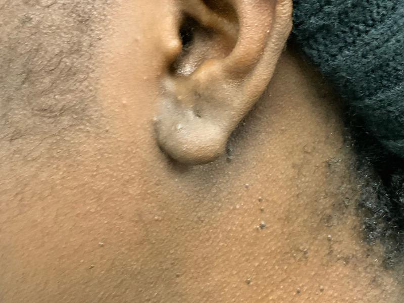 Keloid Removal Before and After | Montilla Plastic Surgery